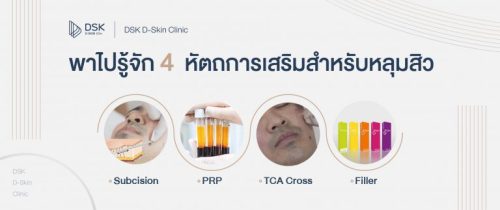 พาไปรู้จัก 4 หัตถการเสริมสำหรับหลุมสิว: Subcision, PRP, TCA Cross และ Filler