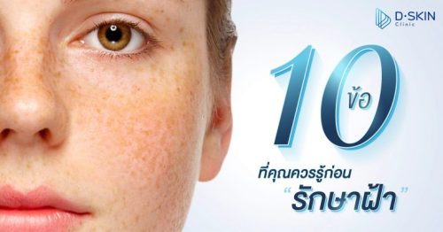 10 ข้อที่คุณควรรู้ก่อน “รักษาฝ้า”