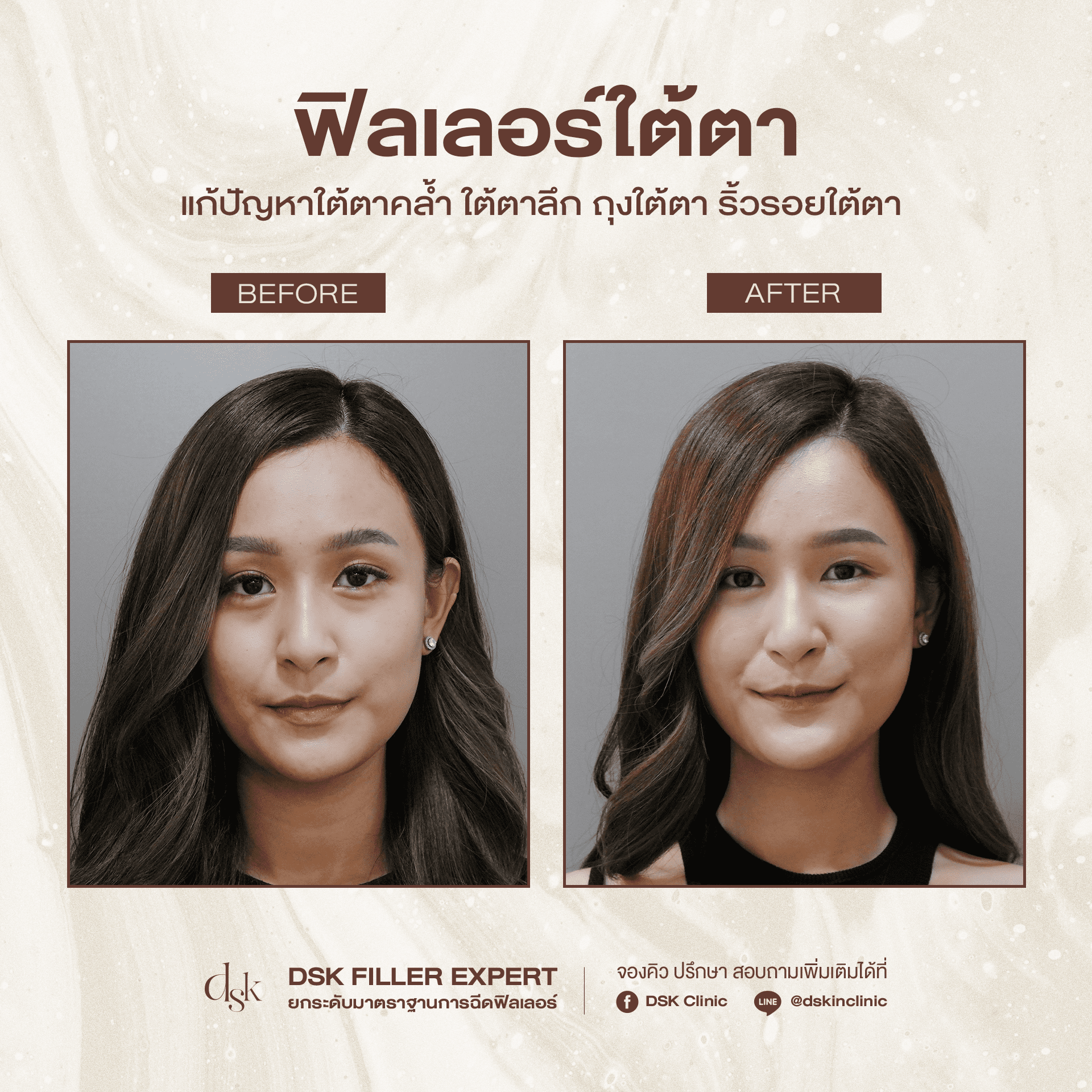 รีวิวฟิลเลอร์ใต้ตา DSK