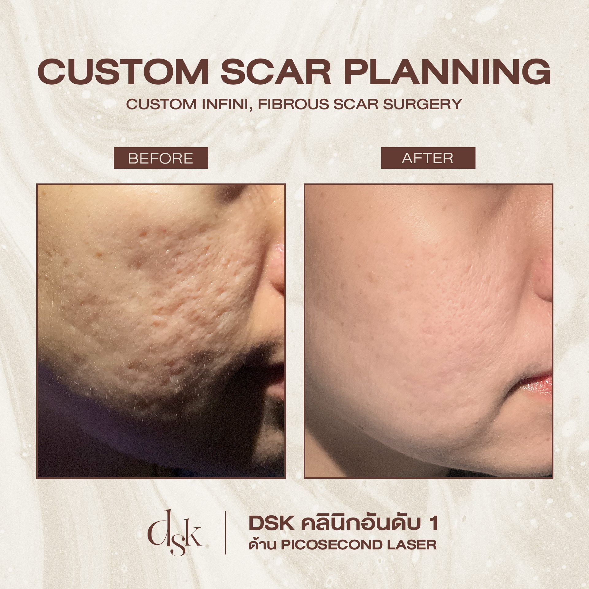 รีวิวรักษาหลุมสิว