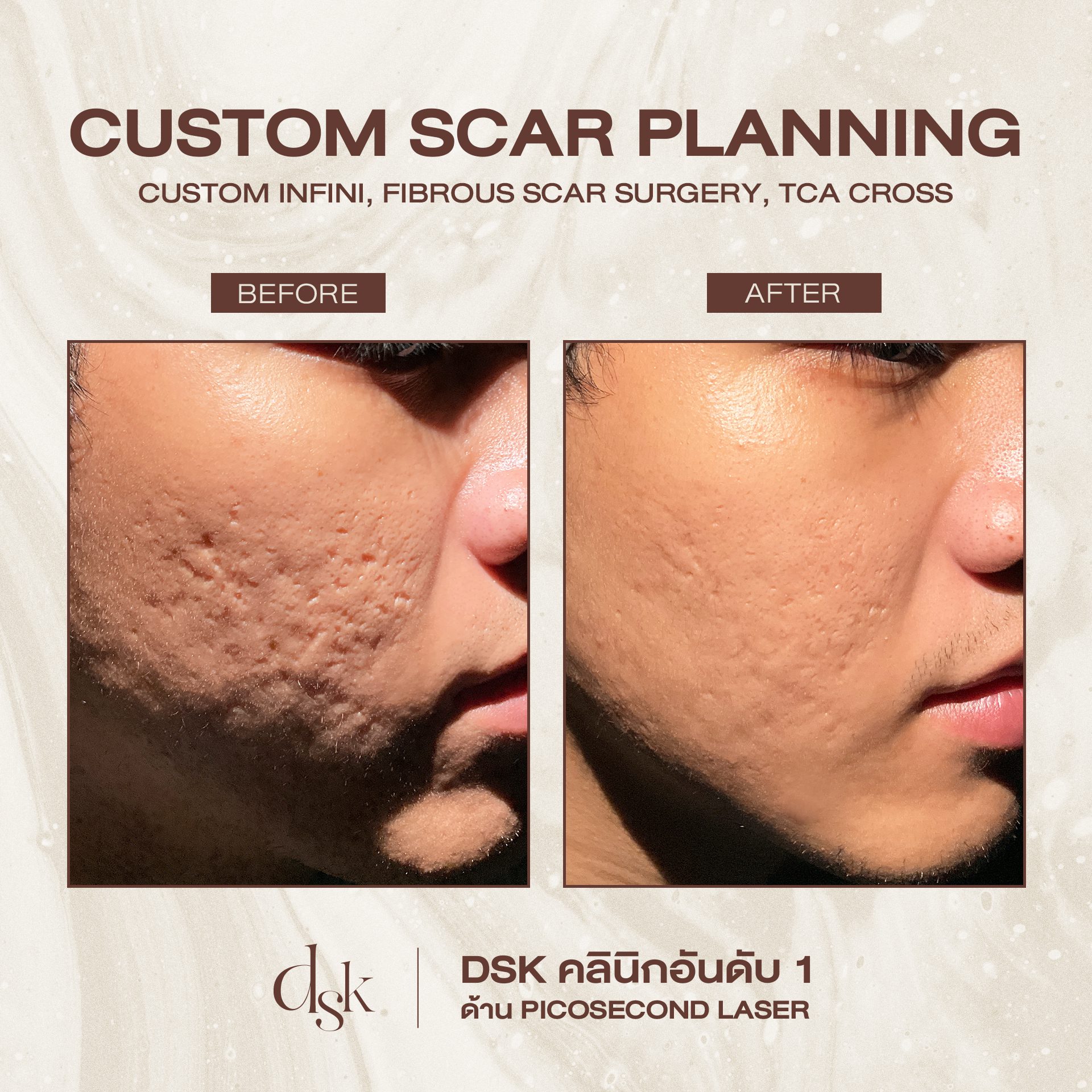 รีวิวหลุมสิว