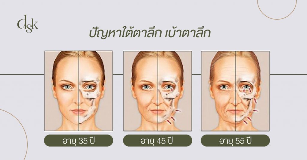 ปัญหาใต้ตาลึก เบ้าตาลึก