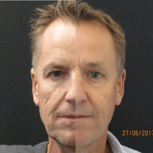 รีวิว Sculptra ผลลัพธ์​ ก่อน-หลังฉีด