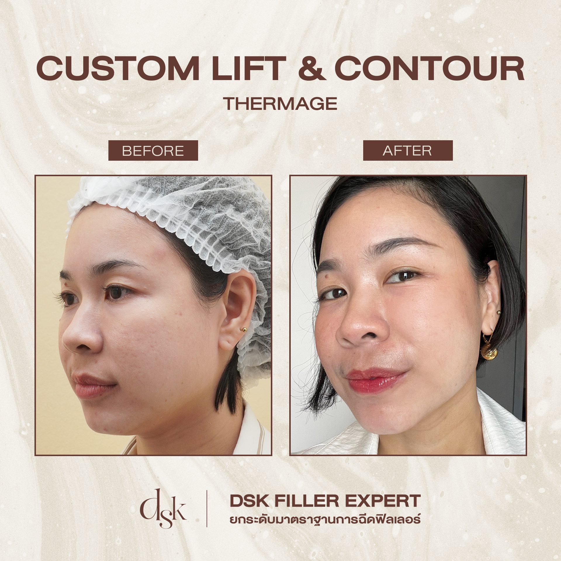 รีวิว Thermage