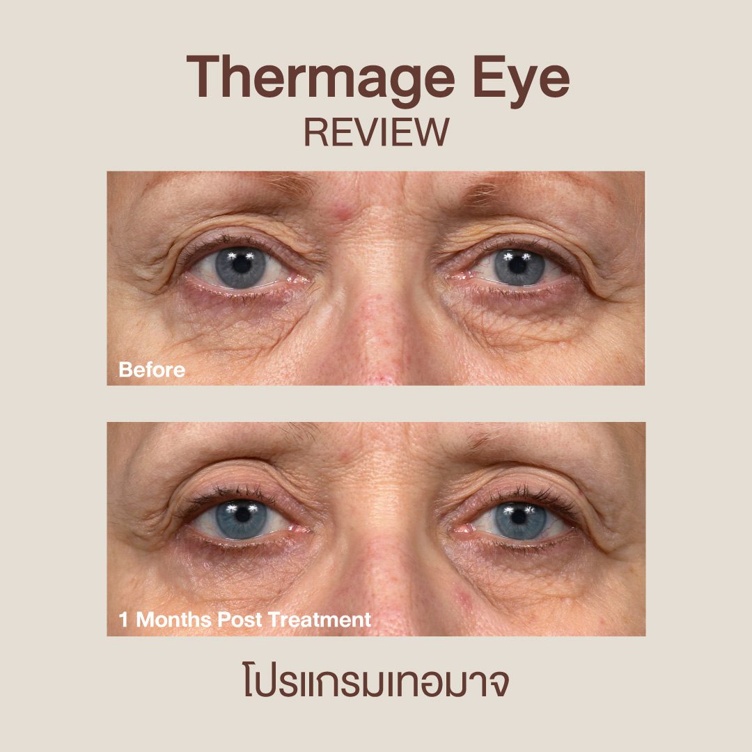 ทำ Thermage Eye ที่ DSK Clinic