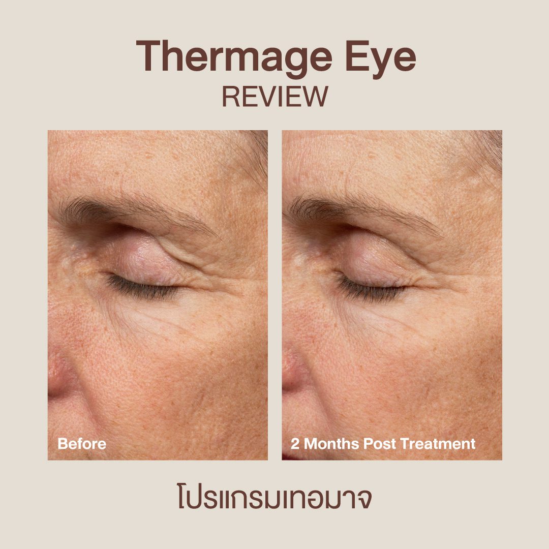 เจาะลึก Thermage Eye เทคโนโลยียกกระชับหนังตา ไม่ผ่าตัดไม่พักฟื้น | DSK ...