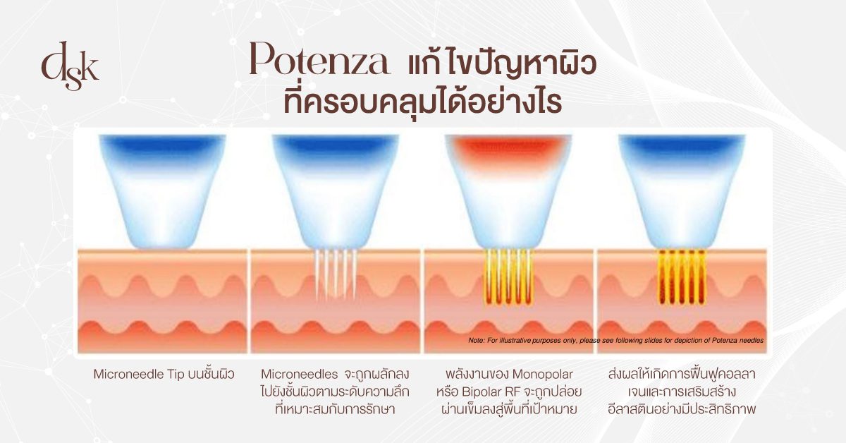 Potenza แก้ไขปัญหาผิวที่ครอบคลุมได้อย่างไร