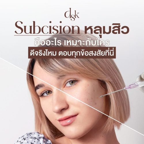 Subcision หลุมสิว คืออะไร เหมาะกับใคร ดีจริงไหม ตอบทุกข้อสงสัยที่นี่