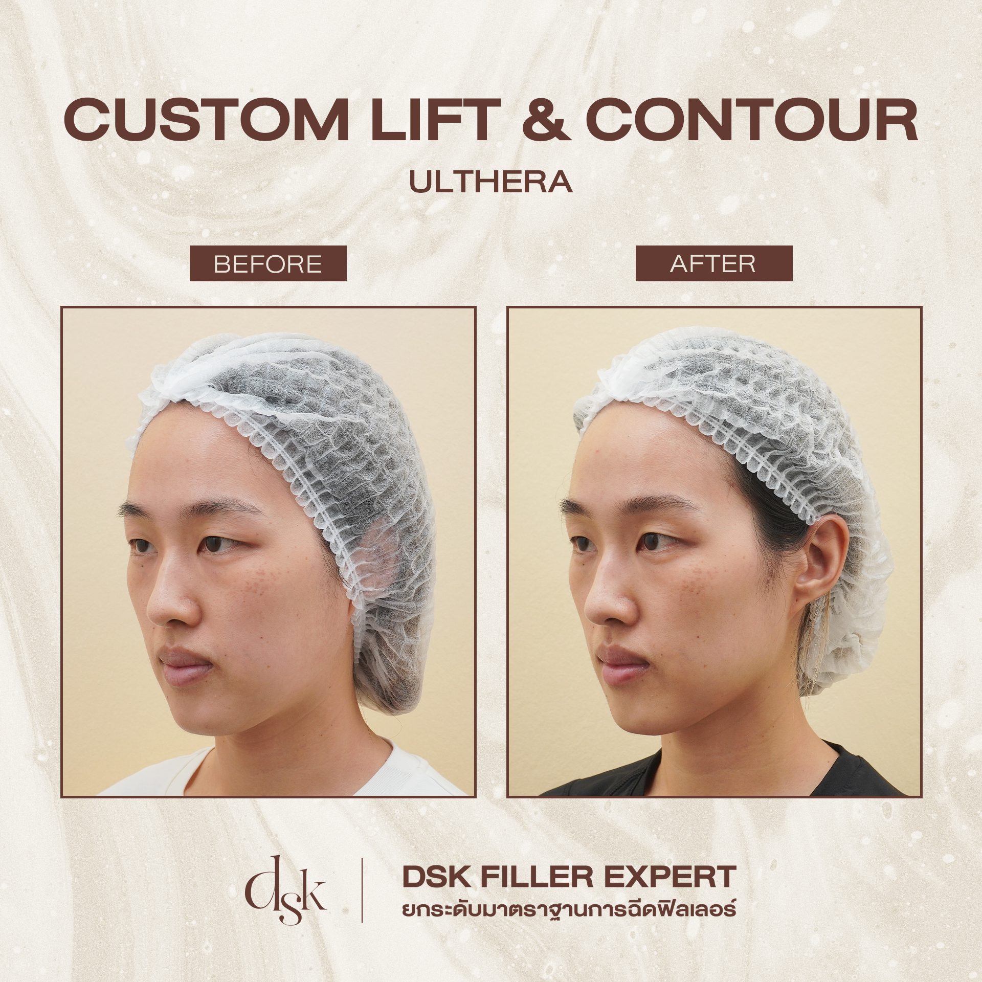 รีวิว ulthera