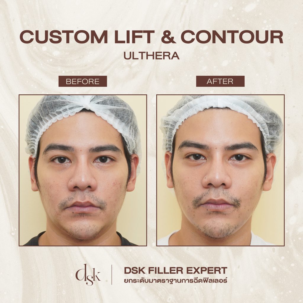 Review Ulthera กับ Thermage DSK Clinic