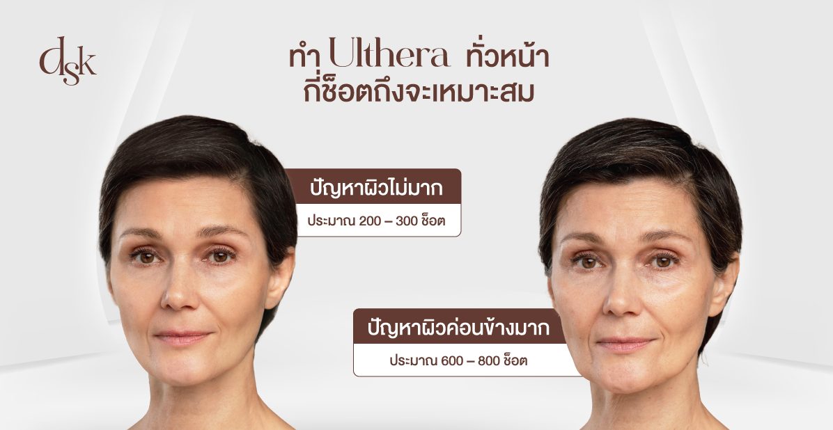 ทำ Ulthera ทั่วหน้ากี่ช็อตถึงจะเหมาะสม