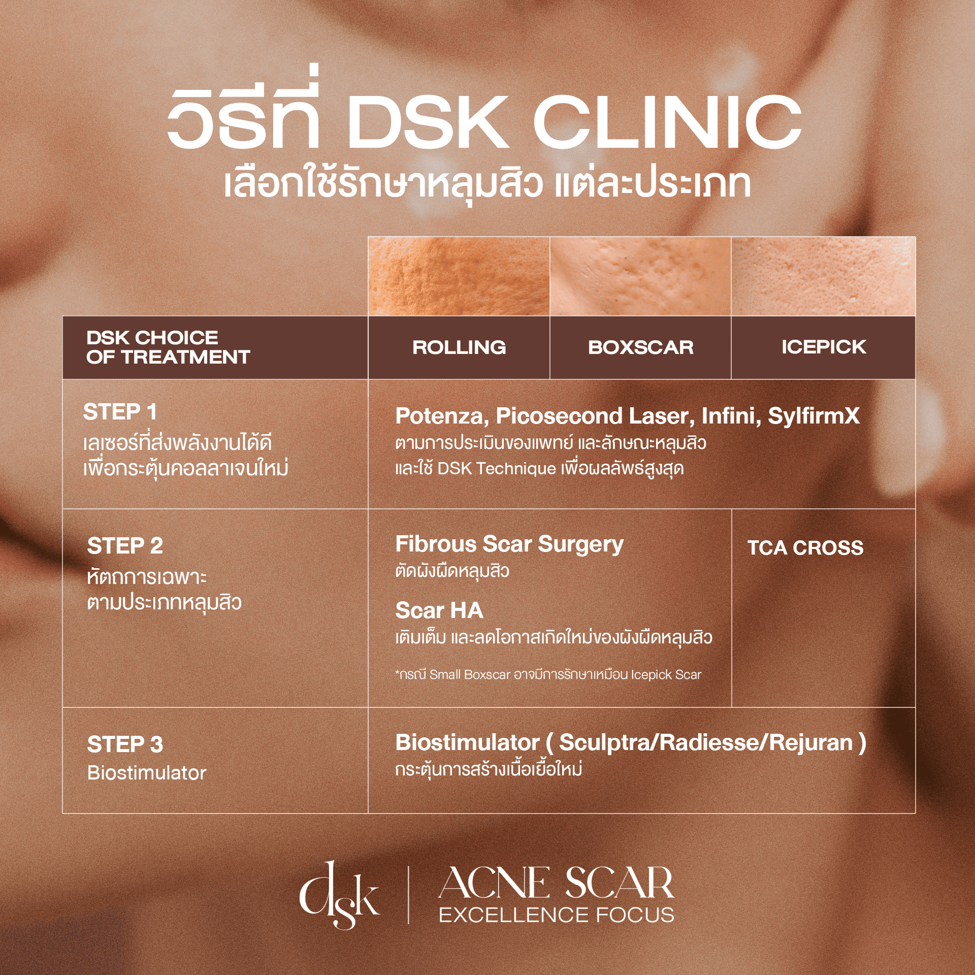 ขั้นตอนการรักษาหลุมสิวด้วย Custom Scar Planning ที่ DSK