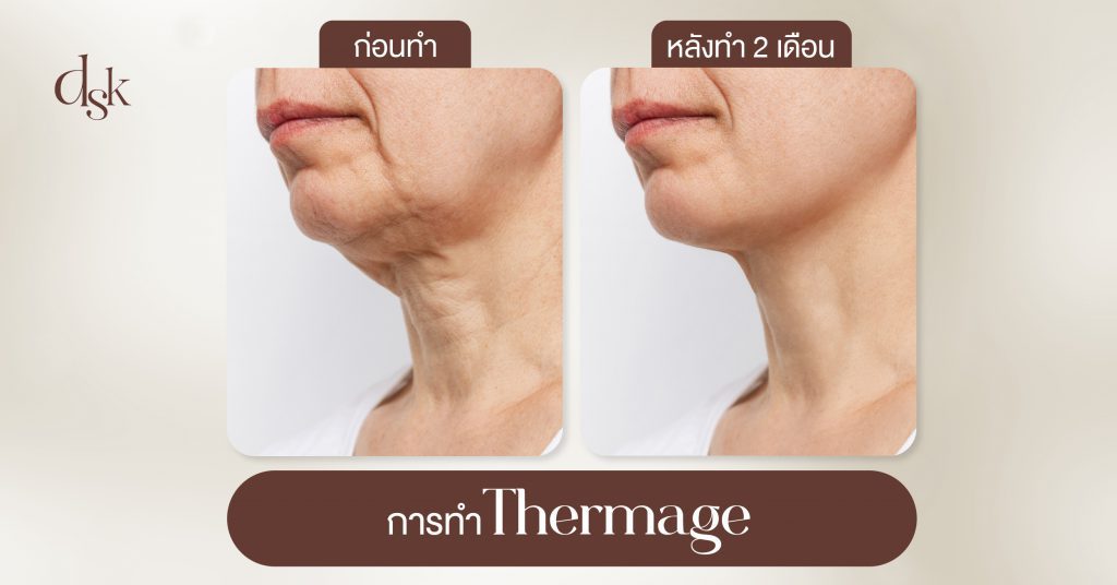 การทำ Thermage