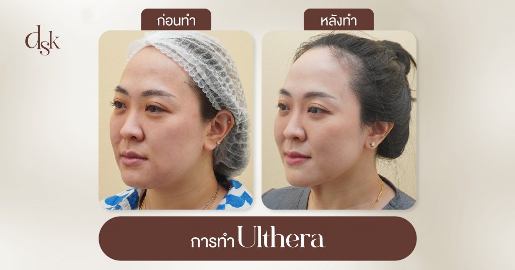  การทำ Ulthera