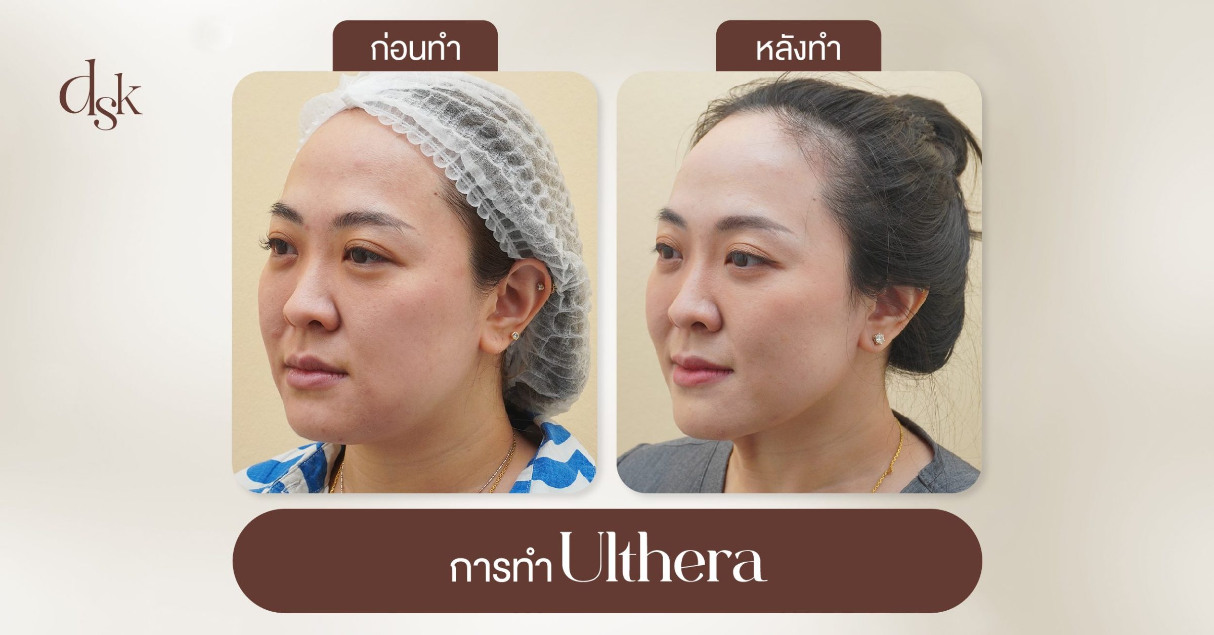 การทำ Ulthera