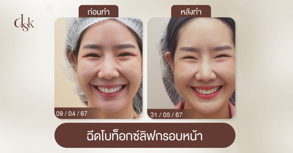 ฉีดโบท็อกซ์ลิฟกรอบหน้า