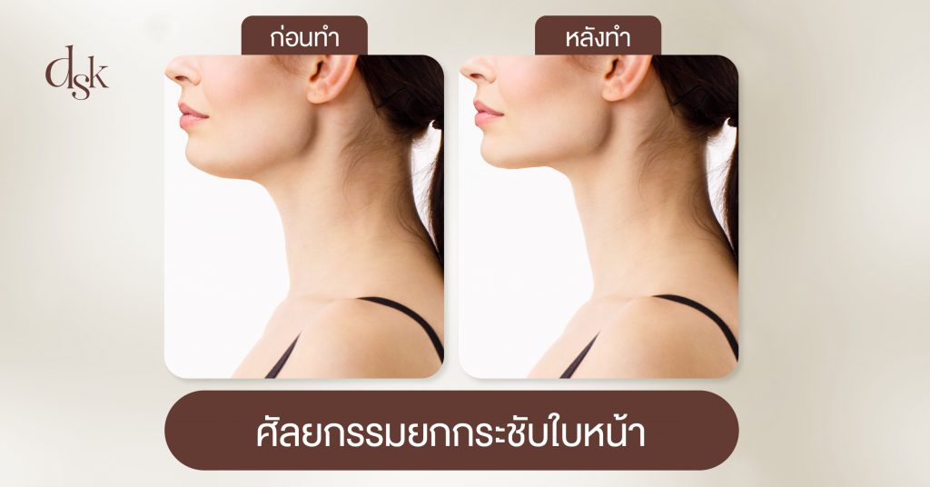 ศัลยกรรมยกกระชับใบหน้า