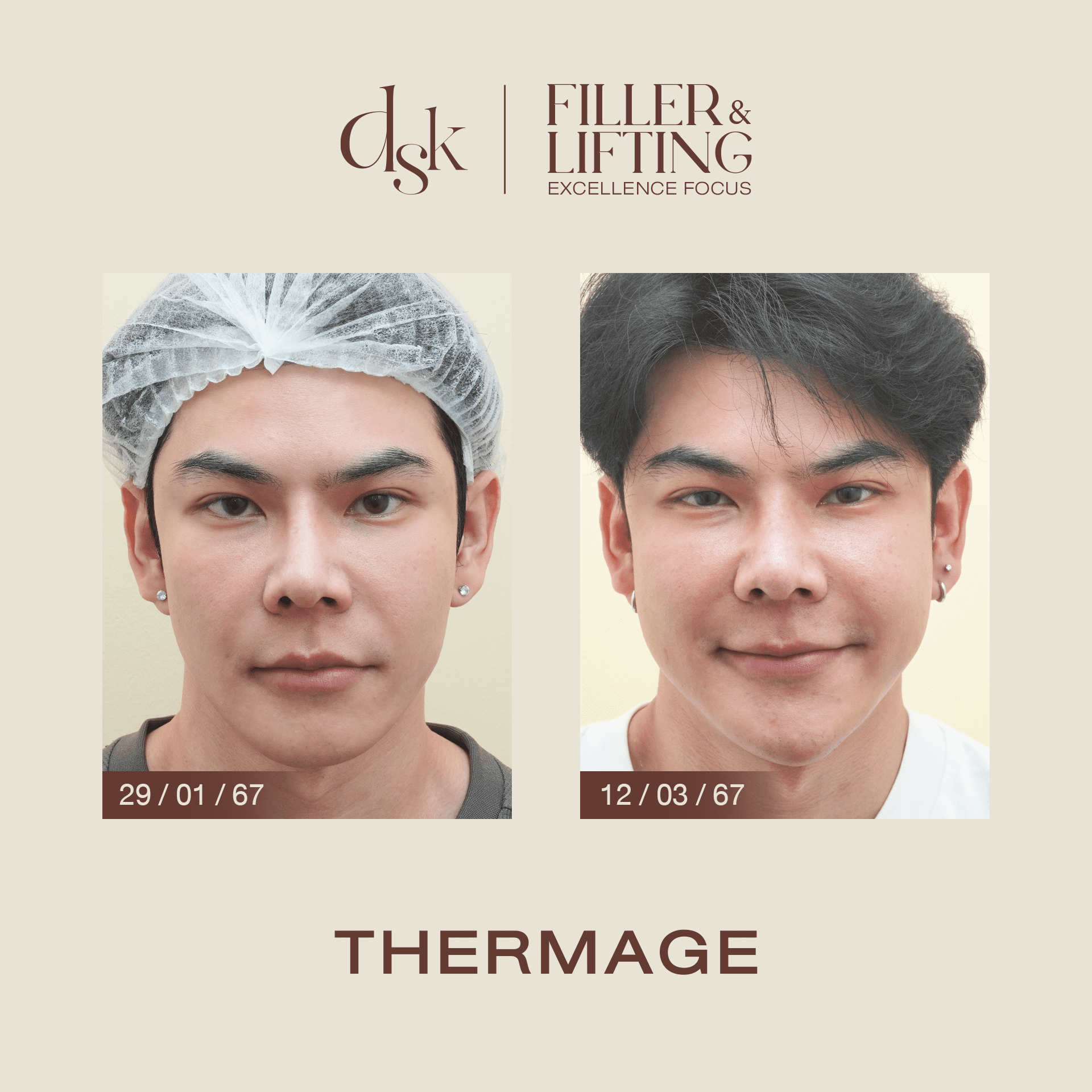 รีวิว Thermage