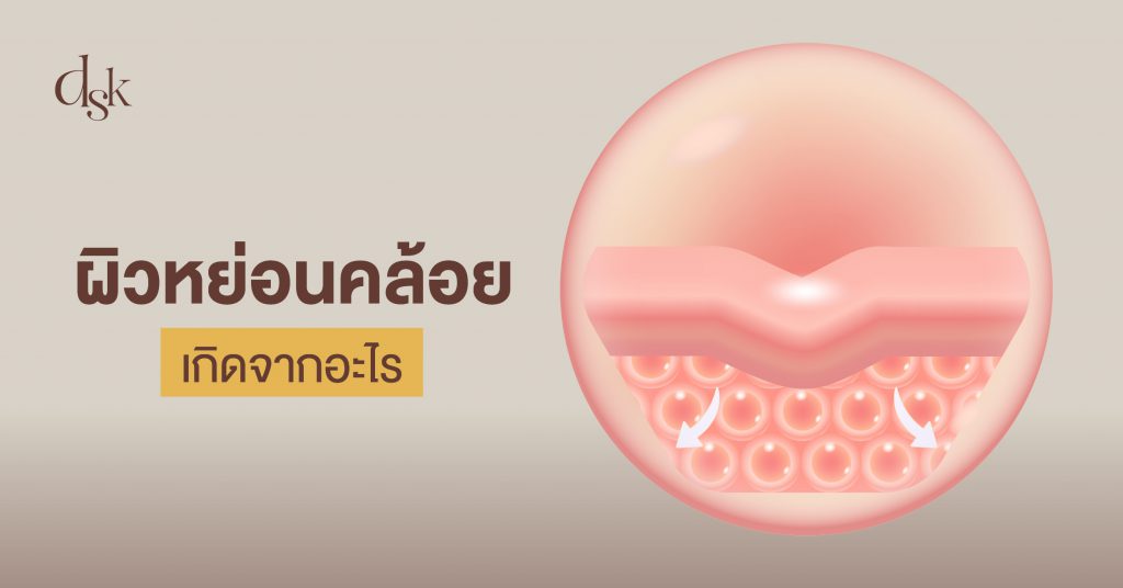 ผิวหย่อนคล้อย เกิดจากอะไร