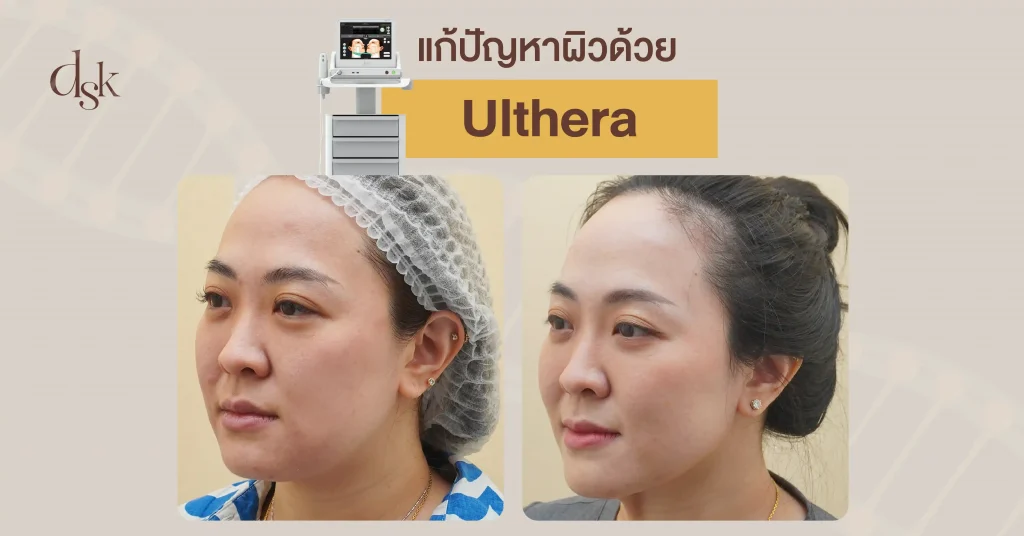 รีวืว แก้ปัญหาผิวด้วย Ulthera