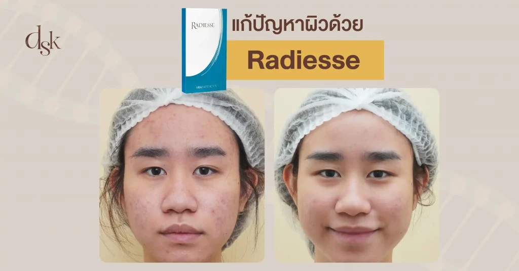 แก้ปัญหาผิวด้วย Radiesse