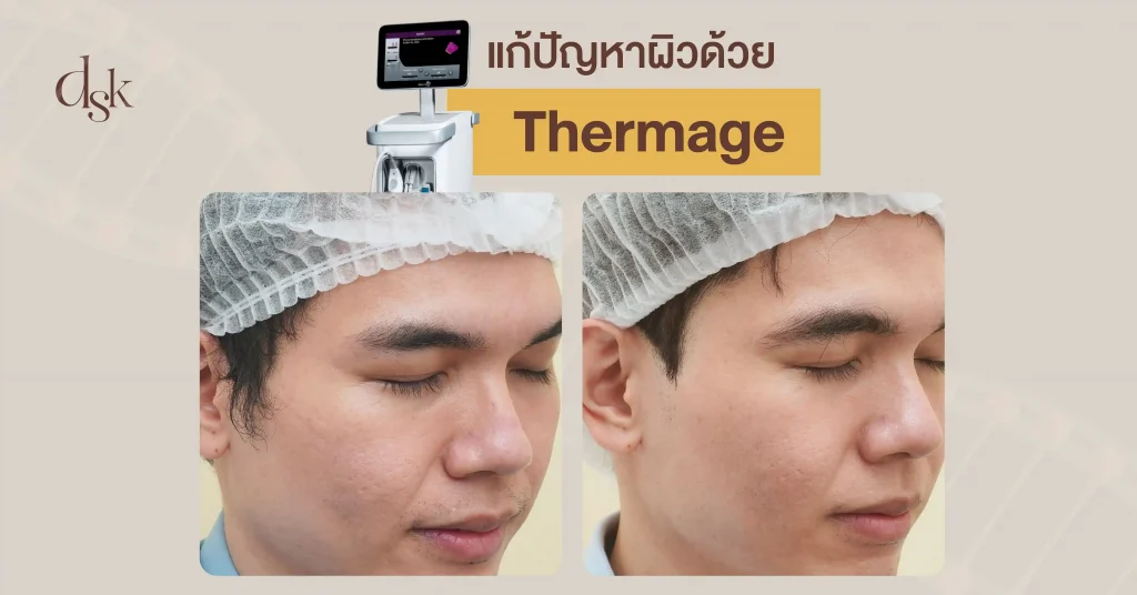 รีวืวแก้ปัญหาผิวด้วย Thermage