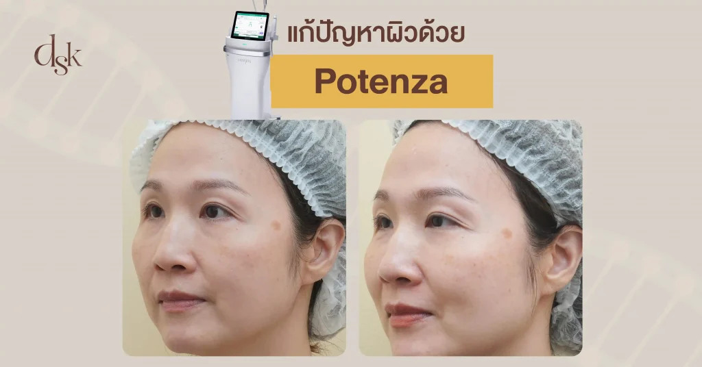 รีวืวแก้ปัญหาผิวด้วย Potenza