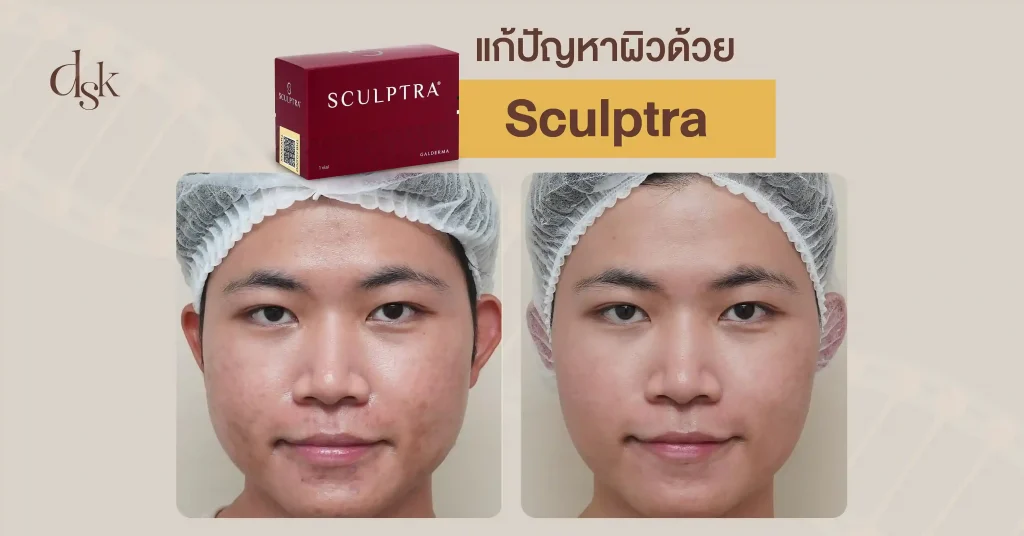 แก้ปัญหาผิวด้วย Sculptra