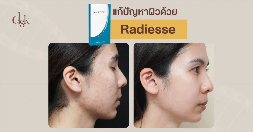 รีวืวแก้ปัญหาผิวด้วย Radiesse