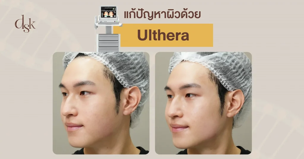 แก้ปัญหาผิวด้วย Ulthera