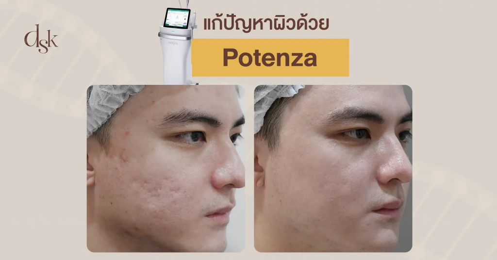 แก้ปัญหาผิวด้วย Potenza