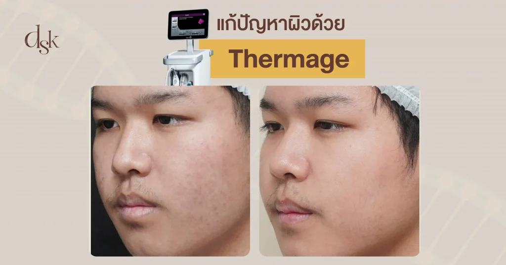 แก้ปัญหาผิวด้วย Thermage