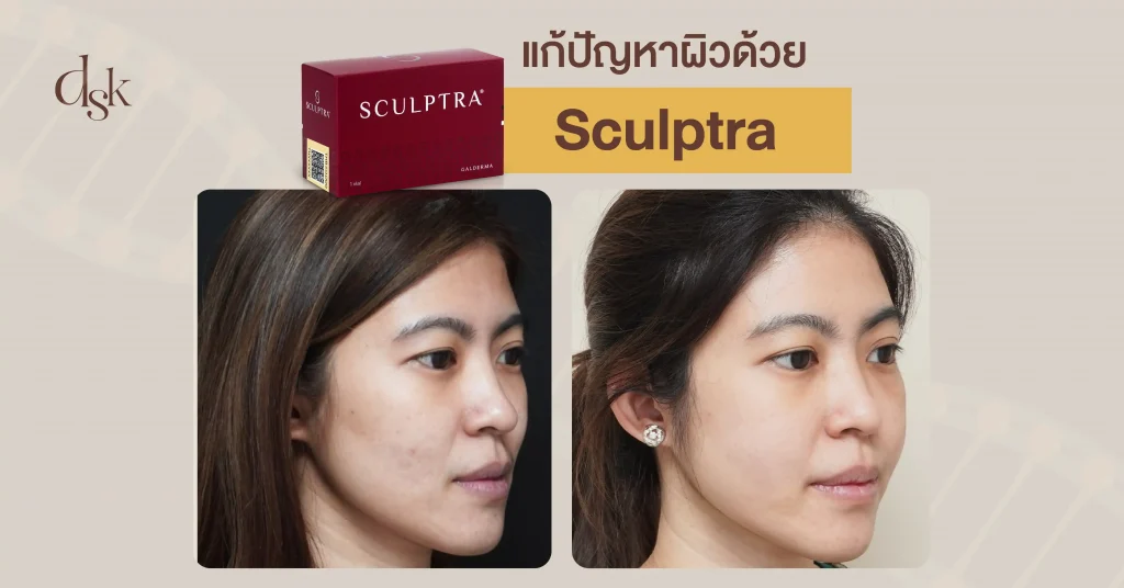 รีวิวแก้ปัญหาผิวด้วย Sculptra