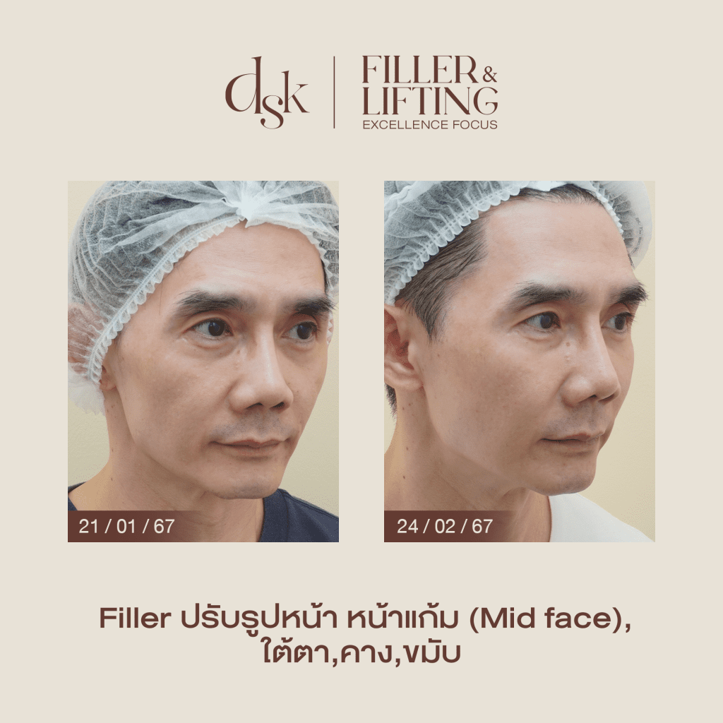 รีวิวฉีดฟิลเลอร์ขมับ ที่ DSK Clinic