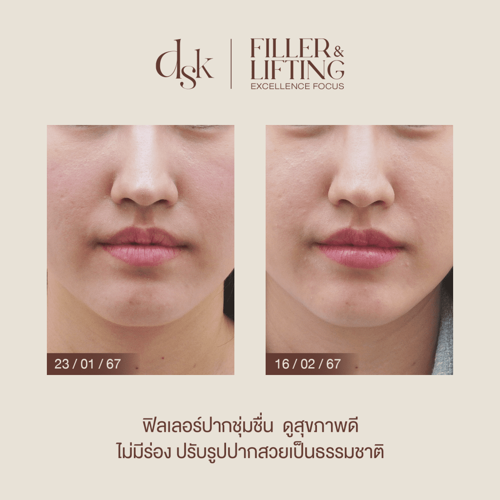 รีวิวฉีดฟิลเลอร์ปากที่ DSK Clinic