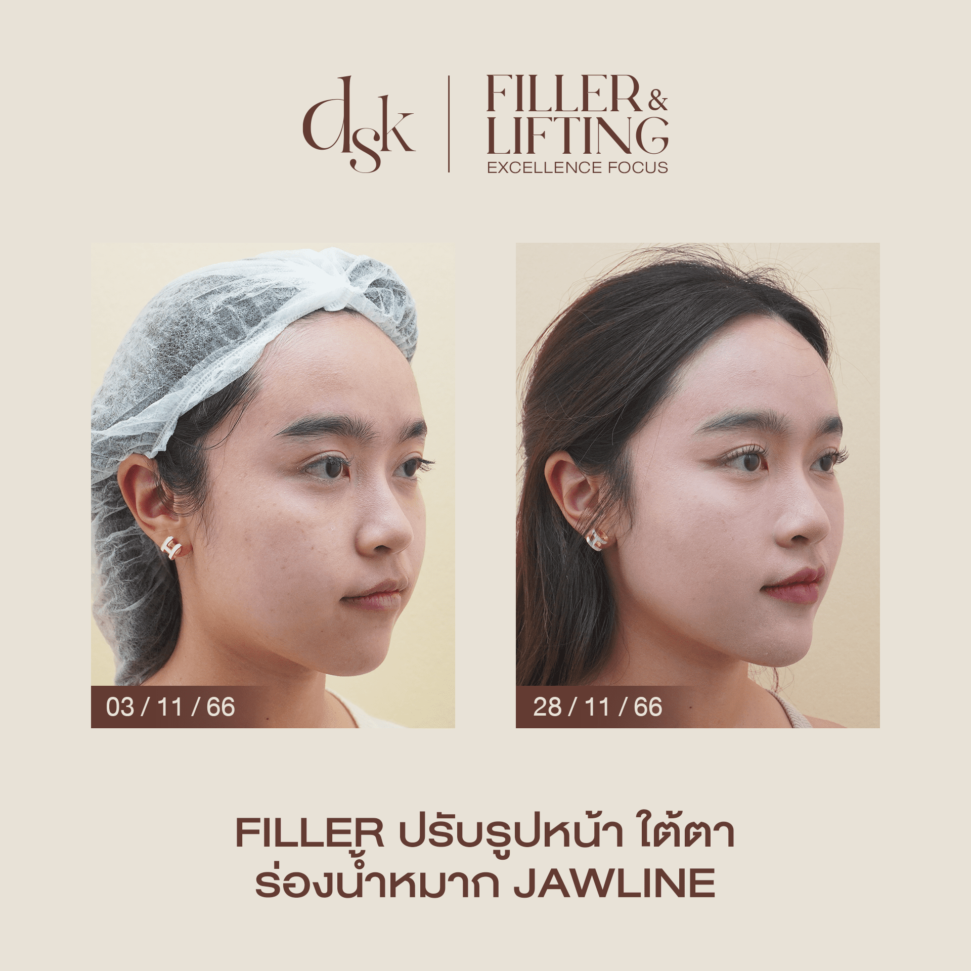 รีวิวฟิลเลอร์ร่องแก้มที่ DSK Clinic