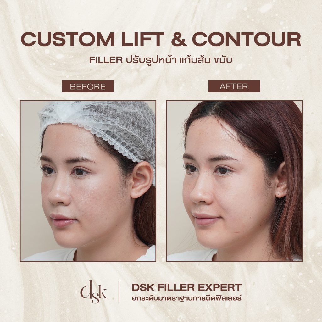 รีวิวการฉีดฟิลเลอร์ ที่ DSK Clinic