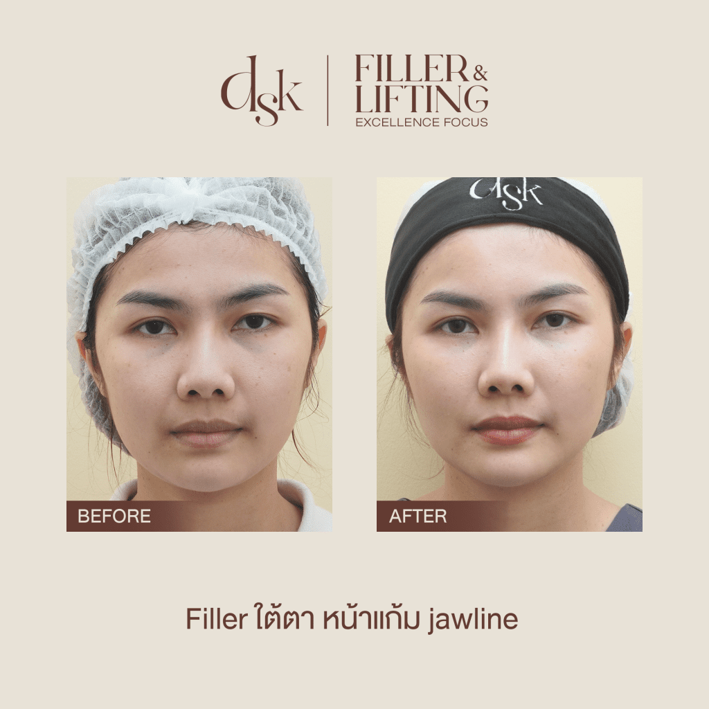 รีวิวการฉีดฟิลเลอร์ ที่ DSK Clinic