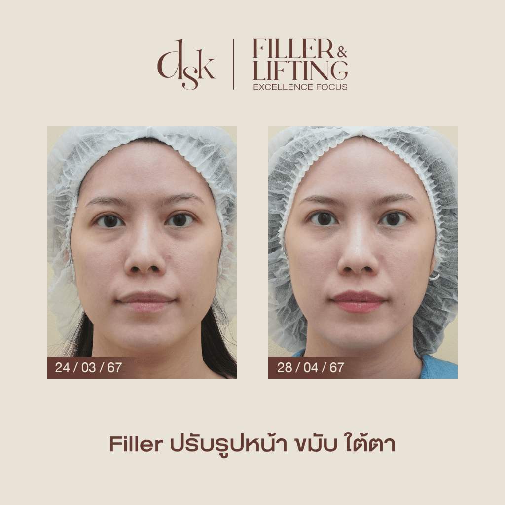 รีวิวการฉีดฟิลเลอร์ ที่ DSK Clinic