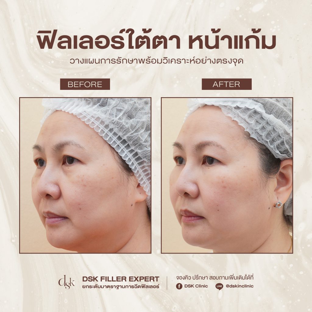 รีวิวการฉีดฟิลเลอร์ ที่ DSK Clinic