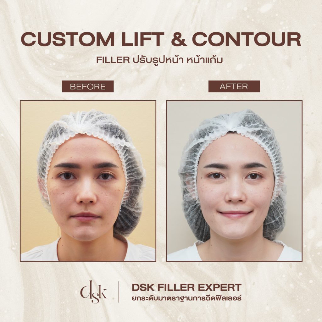 รีวิวการฉีดฟิลเลอร์ ที่ DSK Clinic