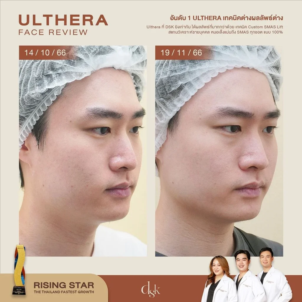 รีวิวทำ Ulthera ที่ DSK Clinic 1