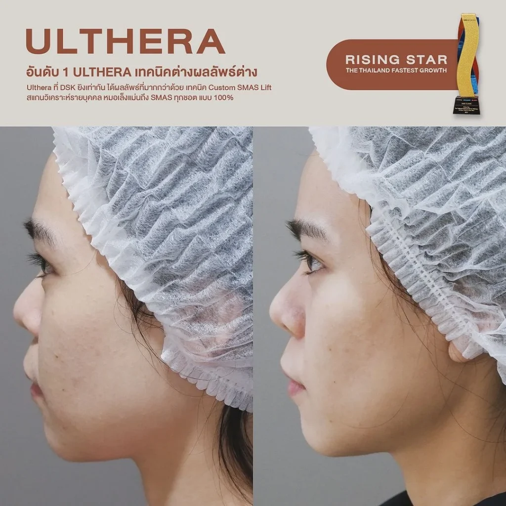 รีวิวทำ Ulthera ที่ DSK Clinic 2