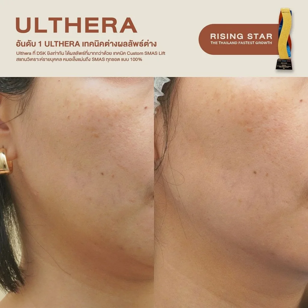 รีวิวทำ Ulthera ที่ DSK Clinic 3