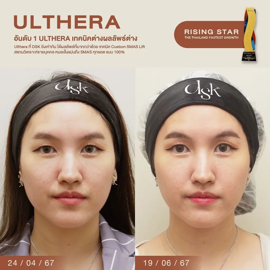 รีวิวทำ Ulthera ที่ DSK Clinic 4