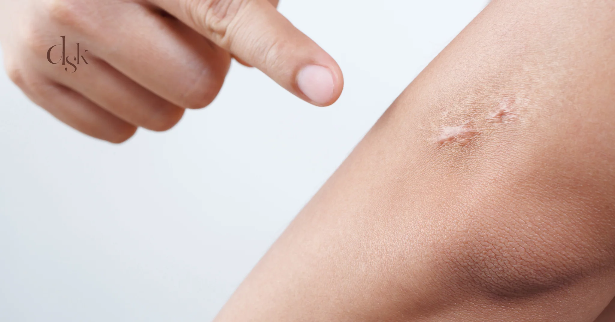 แผลเป็นเกิดจากสาเหตุใด