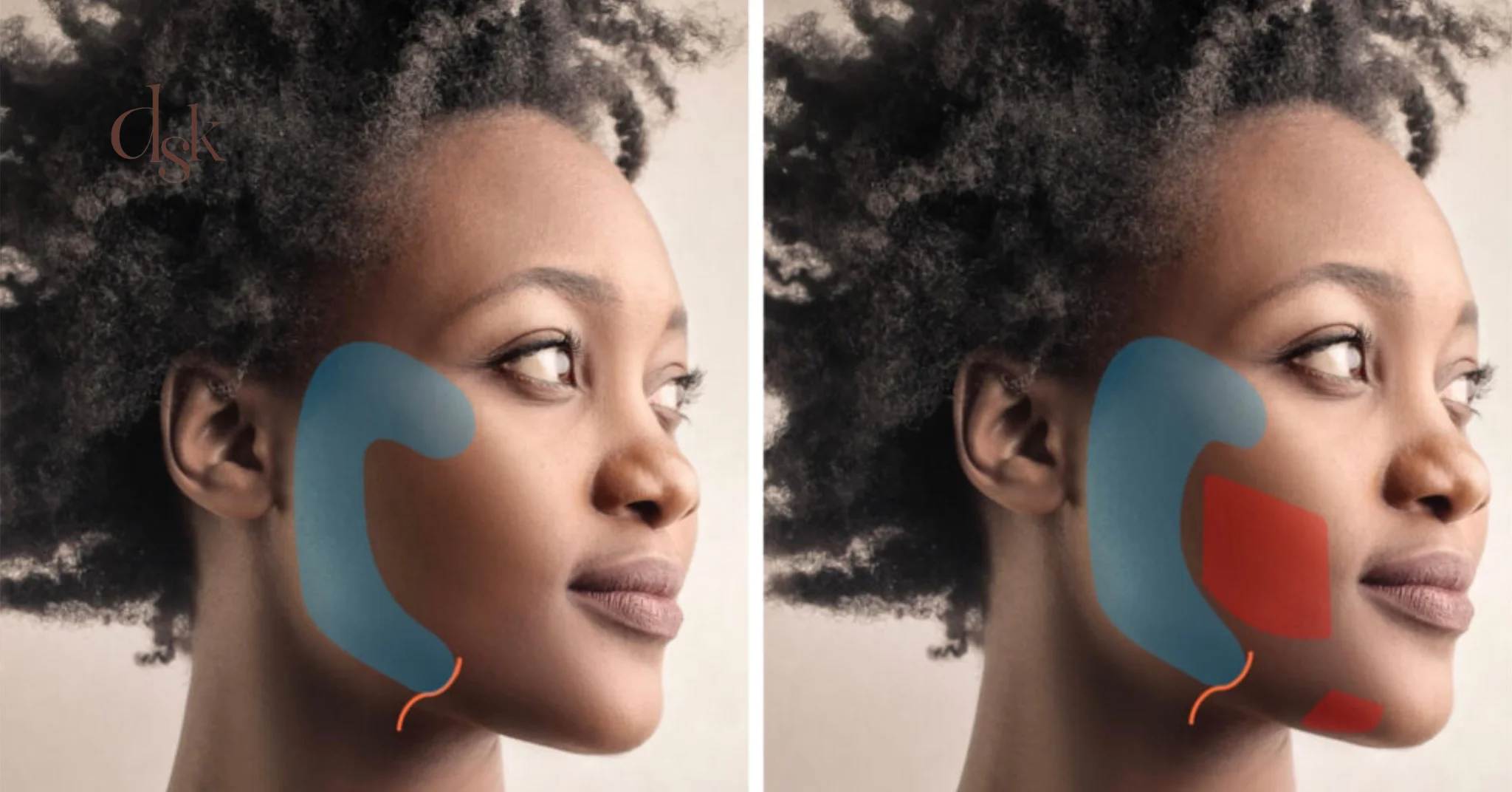 HArmonyCa ฉีดตรงไหนได้บ้าง