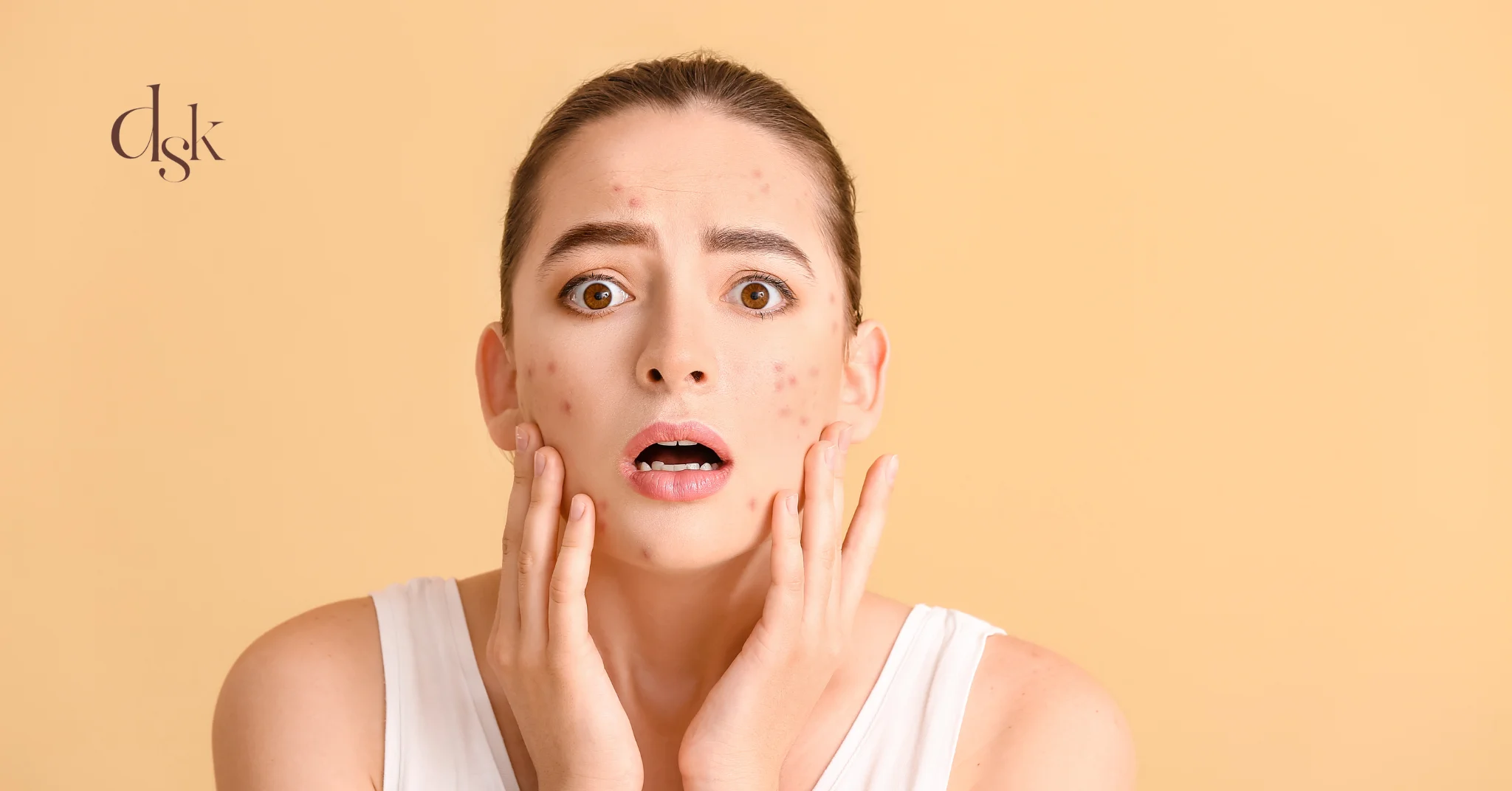 สิวผดคืออะไร