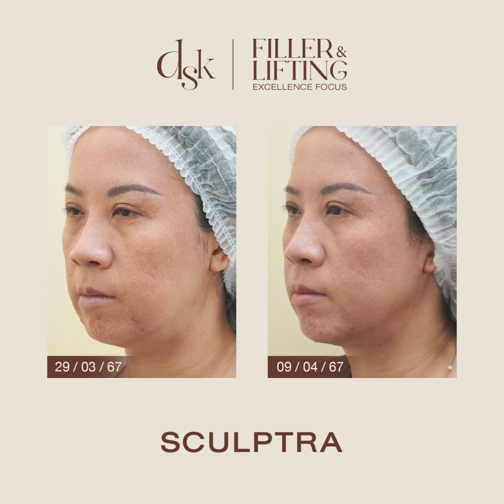 HN.B67-001108_sculptra_dr.prince