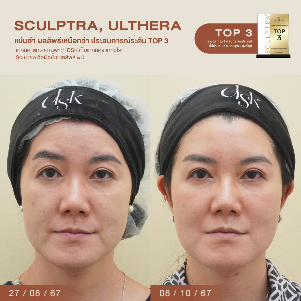 HN.B67-001362_Sculptra